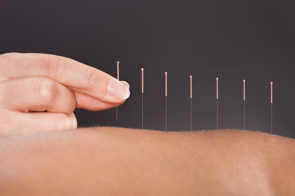 How Much to Tip an Acupuncturist